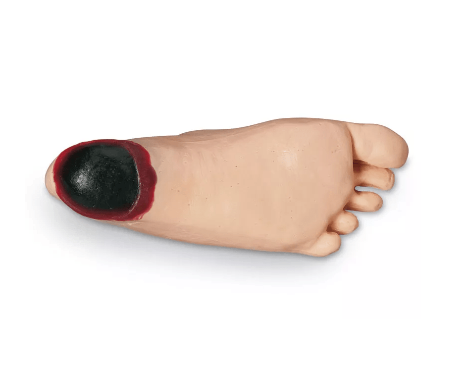 Ödemfuß mit tiefer Gewebsnekrose - Erler - Zimmer